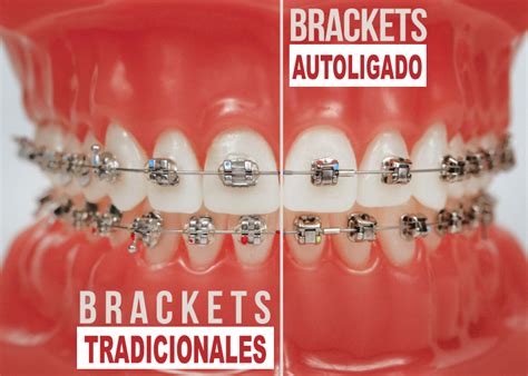 precio brackets metalicos ortodoncia|brackets autoligados.